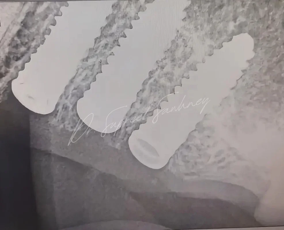 Periapical radiograph showing multiple adjacent dental implants in the posterior jaw